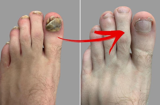 Clavusin Nail Fungus Relief